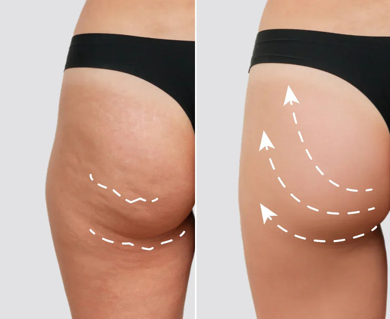 Tschüss Cellulite